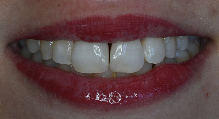 Cierre de diastema