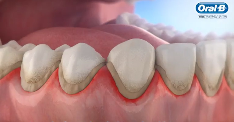 ¿Qué es la Placa Dental?