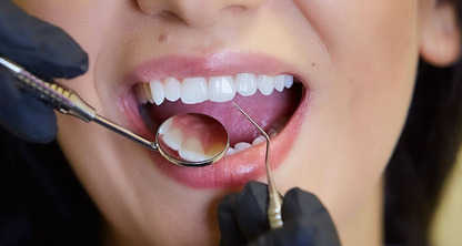 Carillas de porcelana dental