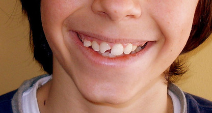 Diente lastimado ¿Qué hacer?