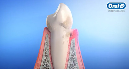 ¿Que es la enfermedad Periodontal?