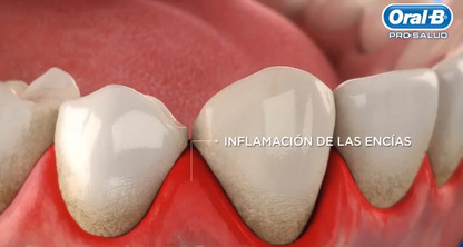 ¿Qué es la Gingivitis?
