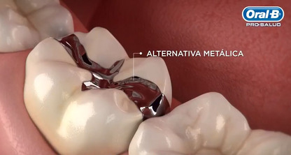 ¿Qué son las incrustaciones dentales?