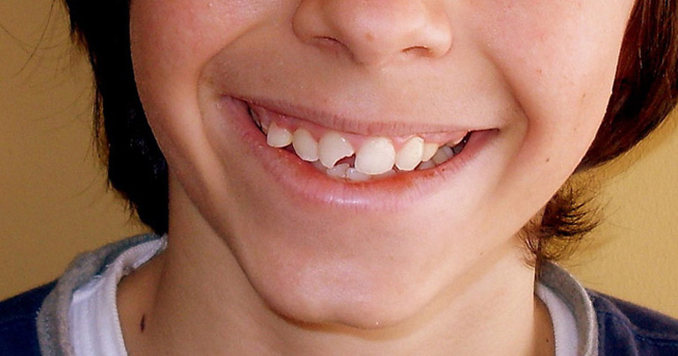 Diente Lastimado ¿Qué Hacer?