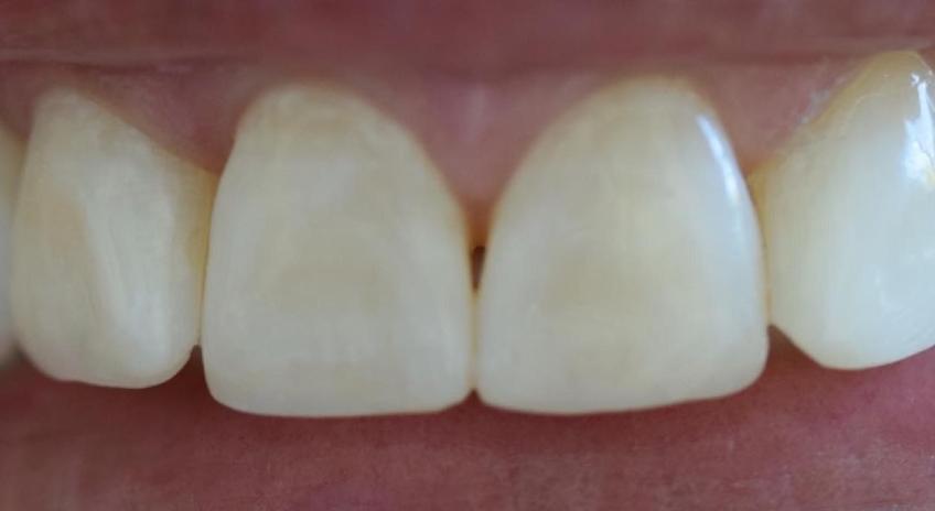 Tratamiento combinado de blanqueamiento dental