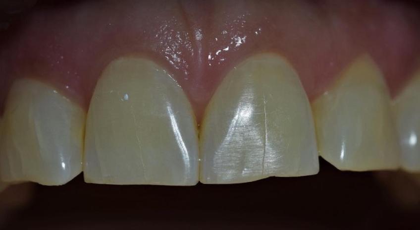 Tratamiento combinado de blanqueamiento dental