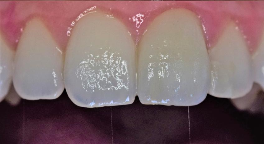 Tratamiento combinado de blanqueamiento dental