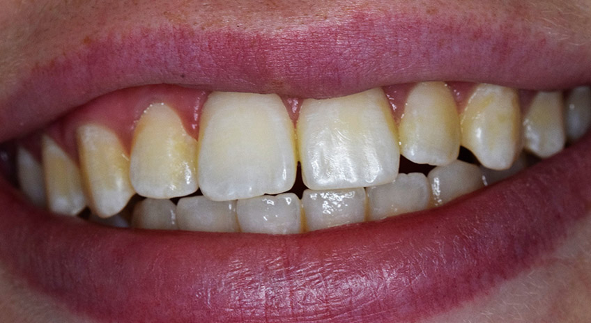 blanqueamiento-01 ANTES