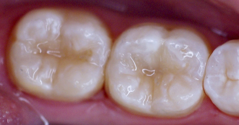 caries DESPUES