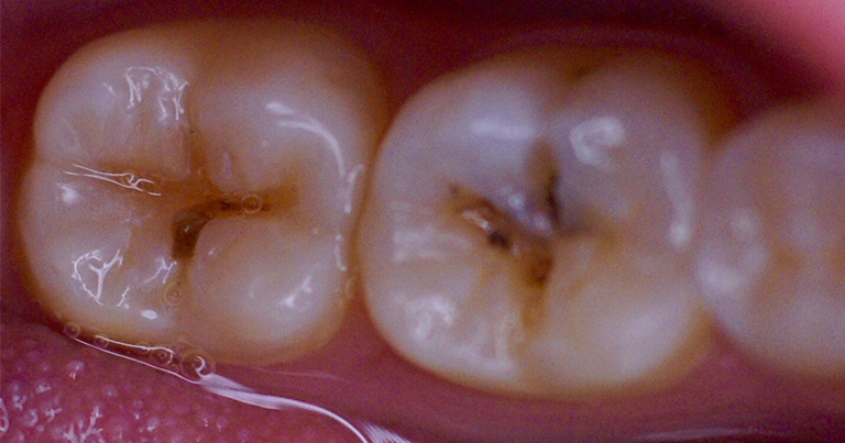caries ANTES