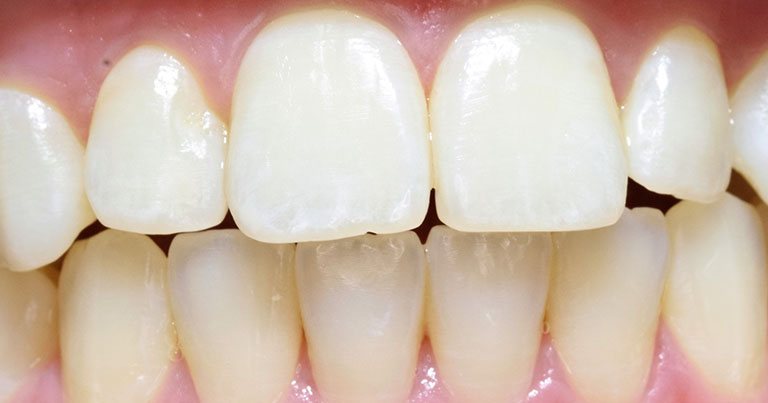 blanqueamiento-00 DESPUES