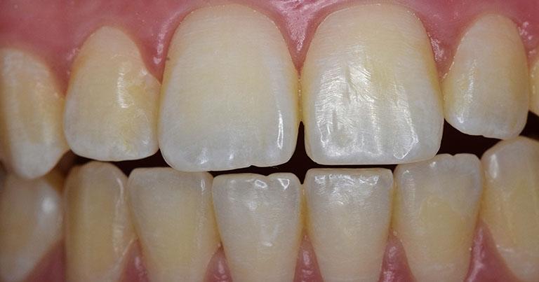 blanqueamiento-00 ANTES