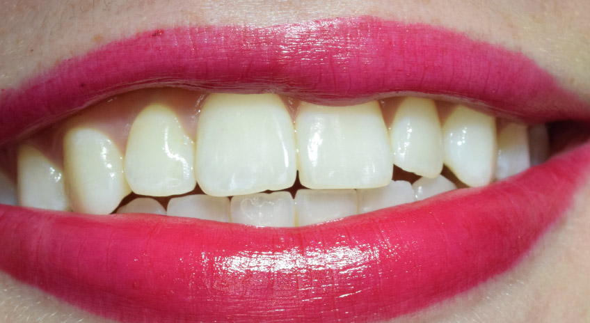 blanqueamiento-01 DESPUES