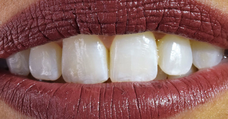 blanqueamiento-02 DESPUES