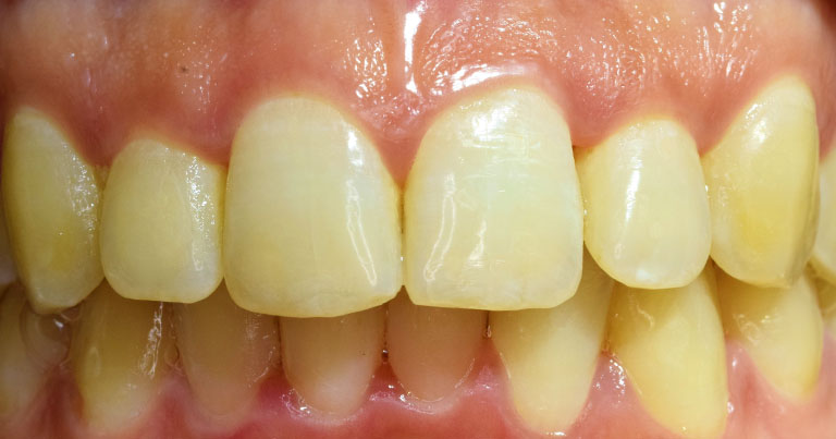 blanqueamiento-02 ANTES