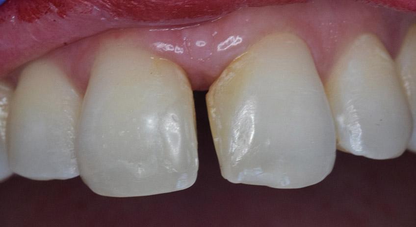 cierre-de-diastema ANTES
