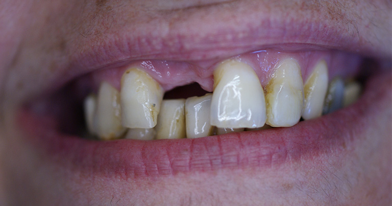 implante-corona ANTES