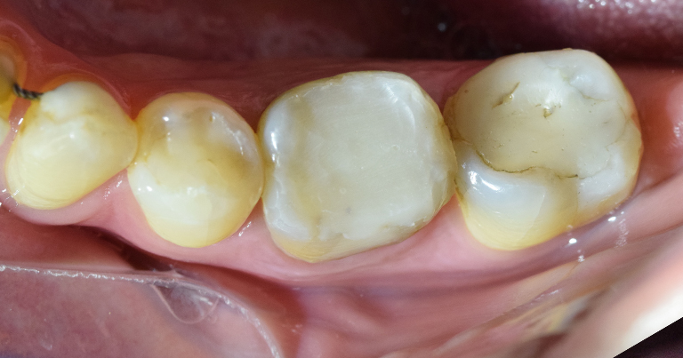 incrustaciones DESPUES