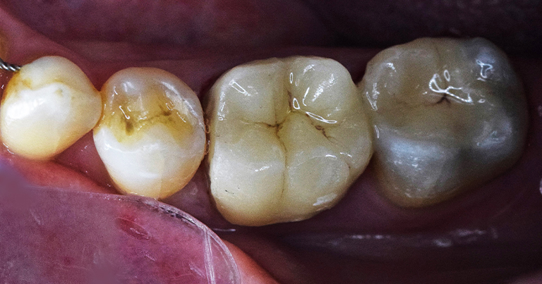 incrustaciones ANTES