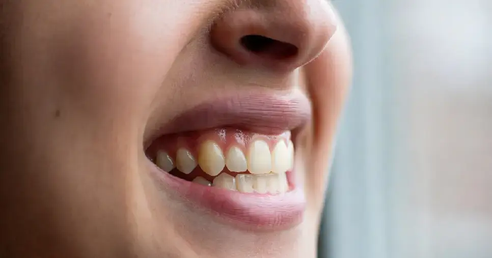 Bruxismo y Placas Miofuncionales