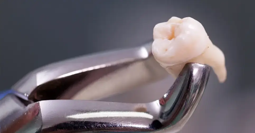 Extracciones Dentales