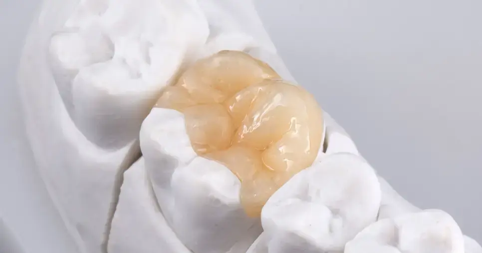 Incrustaciones Dentales