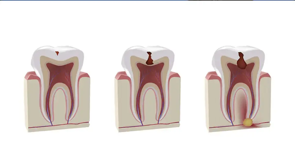 Tratamiento para Caries