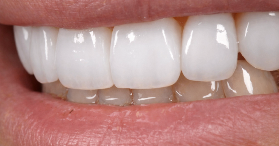 Carillas Dentales